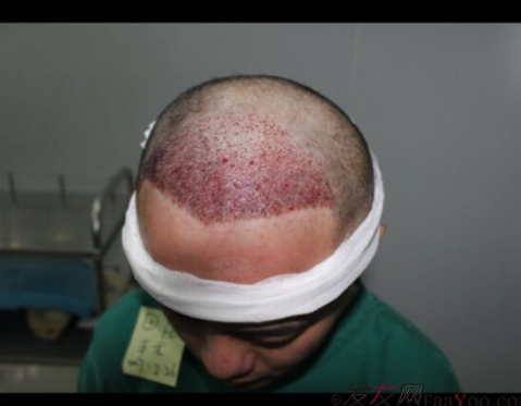 成都大麥微針醫(yī)院3400個(gè)單位，蛻變現(xiàn)在開始！