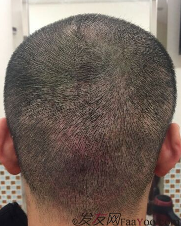 成都大麥微針醫(yī)院3400個(gè)單位，蛻變現(xiàn)在開始！