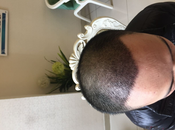 成都大麥微針醫(yī)院3400個(gè)單位，蛻變現(xiàn)在開始！