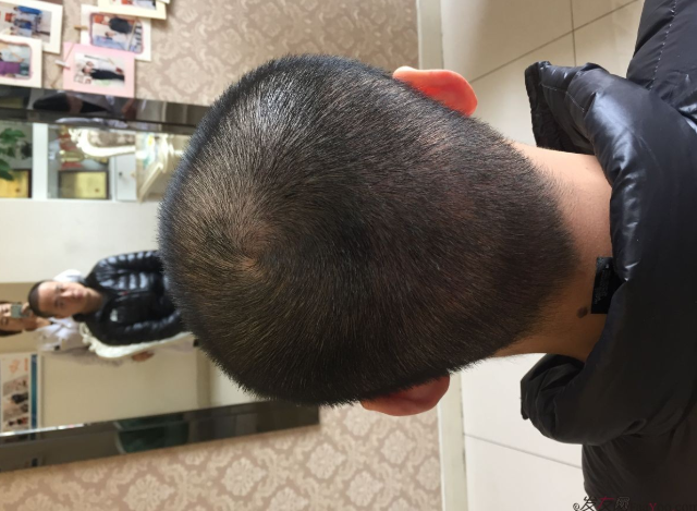 成都大麥微針醫(yī)院3400個(gè)單位，蛻變現(xiàn)在開始！