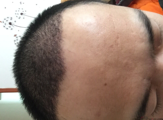 成都大麥微針醫(yī)院3400個(gè)單位，蛻變現(xiàn)在開始！