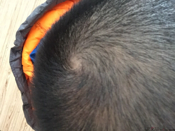 成都大麥微針醫(yī)院3400個(gè)單位，蛻變現(xiàn)在開始！