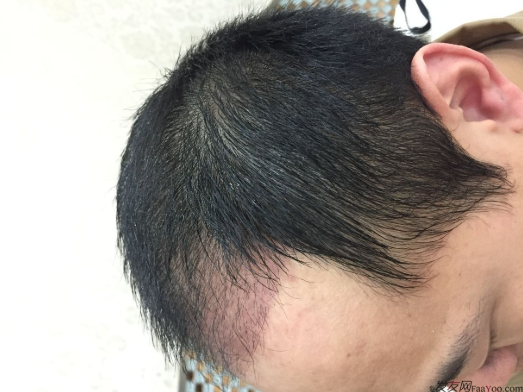 成都大麥微針醫(yī)院3400個(gè)單位，蛻變現(xiàn)在開始！