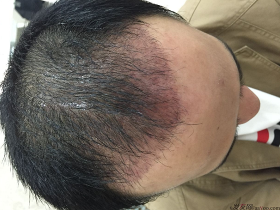 成都大麥微針醫(yī)院3400個(gè)單位，蛻變現(xiàn)在開始！