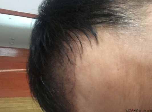 成都大麥微針醫(yī)院3400個(gè)單位，蛻變現(xiàn)在開始！