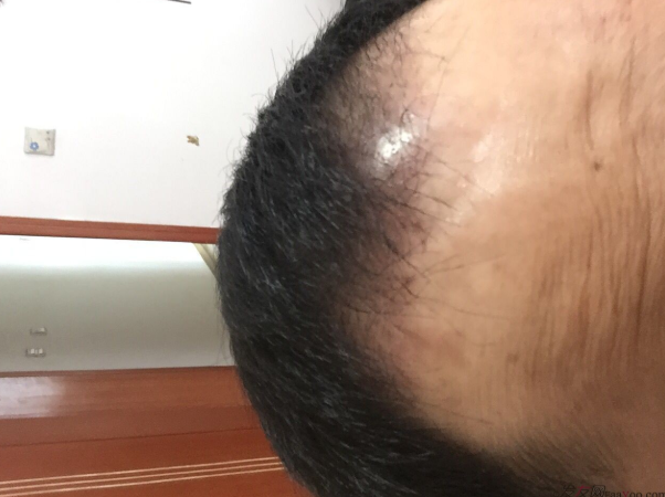 成都大麥微針醫(yī)院3400個(gè)單位，蛻變現(xiàn)在開始！