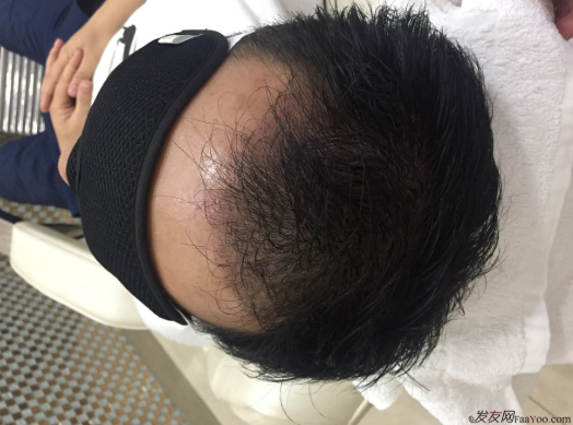 成都大麥微針醫(yī)院3400個(gè)單位，蛻變現(xiàn)在開始！