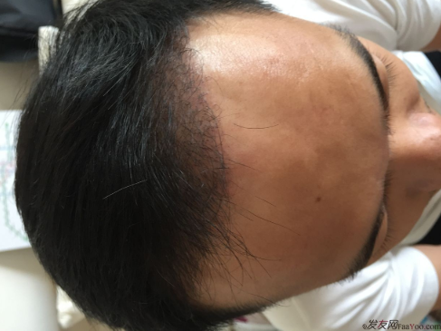 成都大麥微針醫(yī)院3400個(gè)單位，蛻變現(xiàn)在開始！