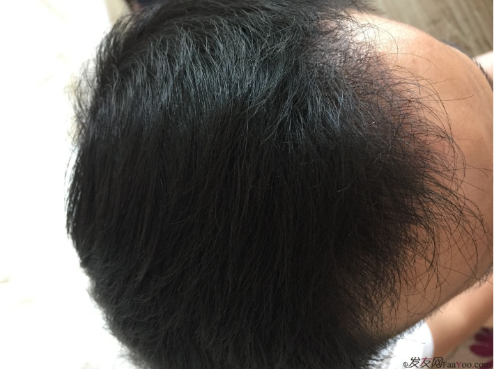 成都大麥微針醫(yī)院3400個(gè)單位，蛻變現(xiàn)在開始！