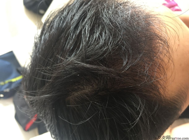 成都大麥微針醫(yī)院3400個(gè)單位，蛻變現(xiàn)在開始！