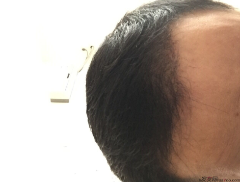 成都大麥微針醫(yī)院3400個(gè)單位，蛻變現(xiàn)在開始！