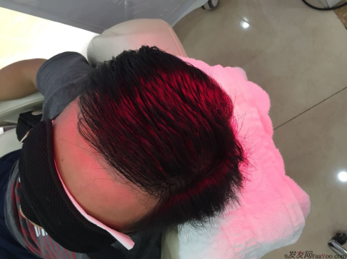 成都大麥微針醫(yī)院3400個(gè)單位，蛻變現(xiàn)在開始！