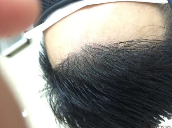 成都大麥微針醫(yī)院3400個(gè)單位，蛻變現(xiàn)在開始！