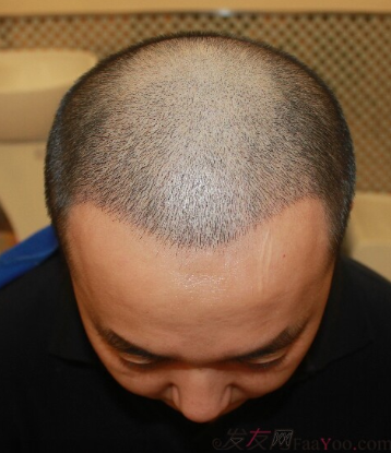 4級脫發(fā)植發(fā)分享我的經(jīng)歷，成都植發(fā)2800單位