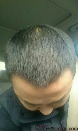 4級脫發(fā)植發(fā)分享我的經(jīng)歷，成都植發(fā)2800單位