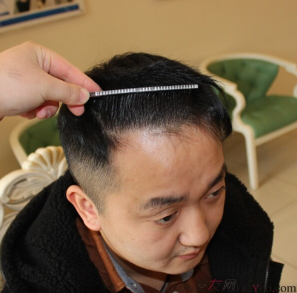 4級脫發(fā)植發(fā)分享我的經(jīng)歷，成都植發(fā)2800單位