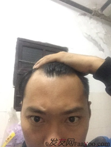 M角前額植發(fā)，選擇大麥微針終究是選擇對了