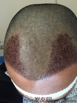 M角前額植發(fā)，選擇大麥微針終究是選擇對了