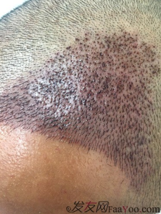 M角前額植發(fā)，選擇大麥微針終究是選擇對了