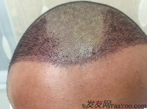 M角前額植發(fā)，選擇大麥微針終究是選擇對了