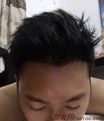 M角前額植發(fā)，選擇大麥微針終究是選擇對了