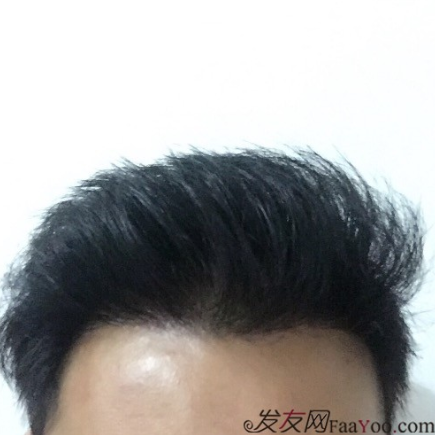 M角前額植發(fā)，選擇大麥微針終究是選擇對了