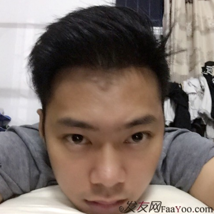 M角前額植發(fā)，選擇大麥微針終究是選擇對了