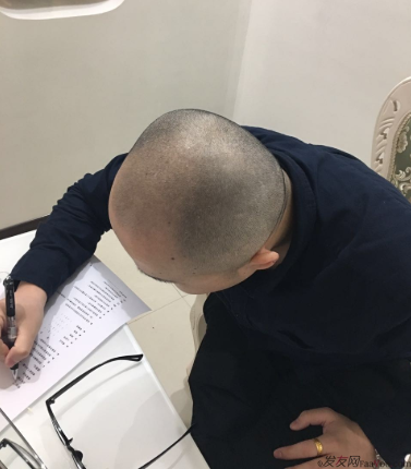 三級脫發(fā)植發(fā)，在鄭州大麥微針植發(fā)2700pse+200ptt+st&nbsp;