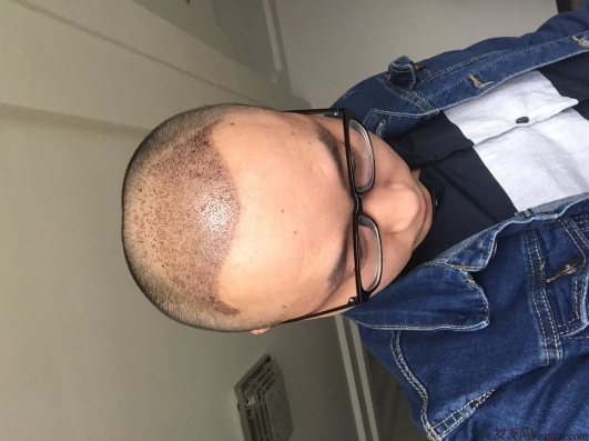 三級脫發(fā)植發(fā)，在鄭州大麥微針植發(fā)2700pse+200ptt+st&nbsp;