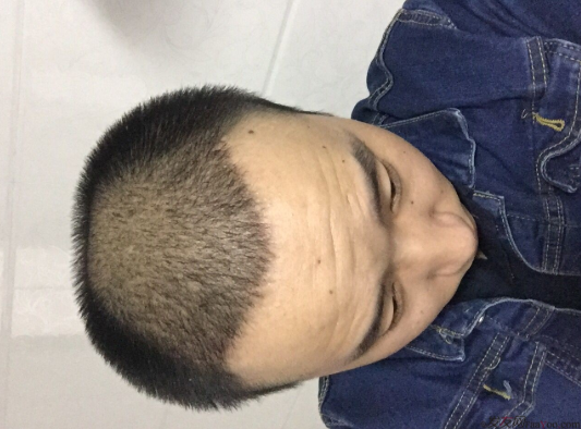 三級脫發(fā)植發(fā)，在鄭州大麥微針植發(fā)2700pse+200ptt+st&nbsp;