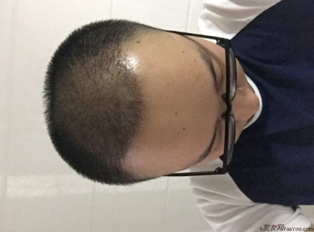 三級脫發(fā)植發(fā)，在鄭州大麥微針植發(fā)2700pse+200ptt+st&nbsp;