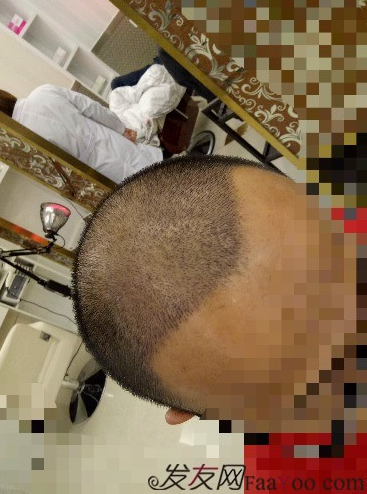 我在青島大麥微針植了發(fā)，3600單位期待我的蛻變