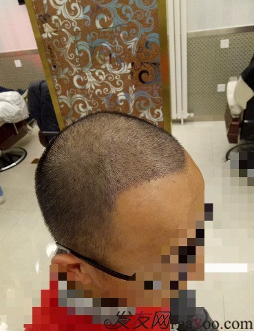 我在青島大麥微針植了發(fā)，3600單位期待我的蛻變