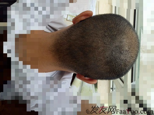 我在青島大麥微針植了發(fā)，3600單位期待我的蛻變