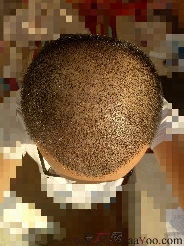 我在青島大麥微針植了發(fā)，3600單位期待我的蛻變