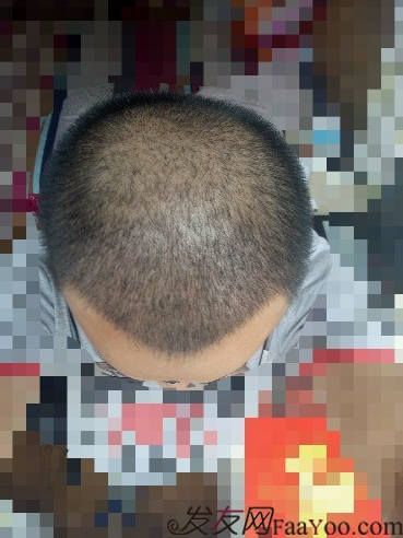 我在青島大麥微針植了發(fā)，3600單位期待我的蛻變