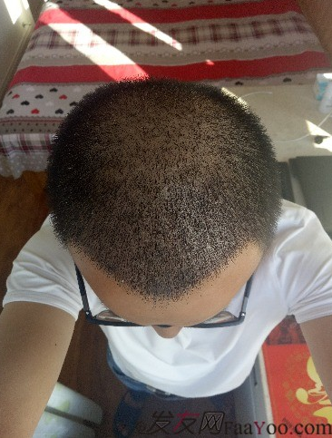 我在青島大麥微針植了發(fā)，3600單位期待我的蛻變