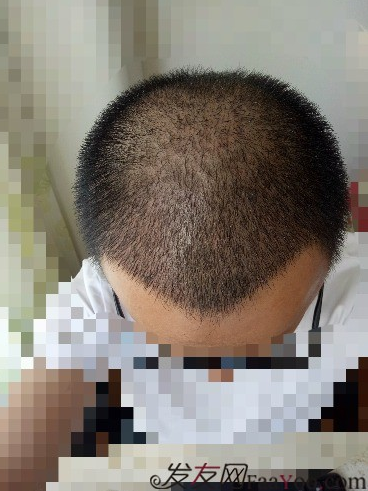 我在青島大麥微針植了發(fā)，3600單位期待我的蛻變