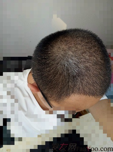 我在青島大麥微針植了發(fā)，3600單位期待我的蛻變