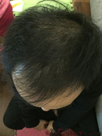 長沙大麥微針植發(fā)3510單位，一步步變帥的過程