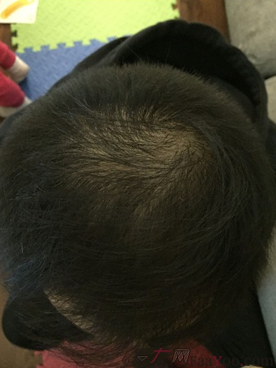 長沙大麥微針植發(fā)3510單位，一步步變帥的過程