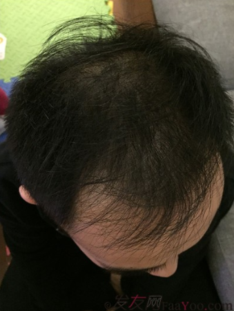 長沙大麥微針植發(fā)3510單位，一步步變帥的過程