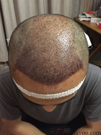 長沙大麥微針植發(fā)3510單位，一步步變帥的過程