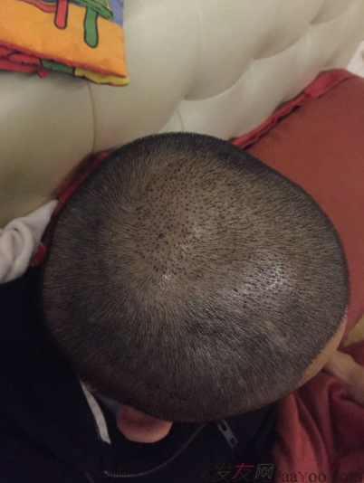 長沙大麥微針植發(fā)3510單位，一步步變帥的過程