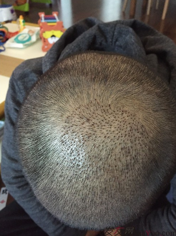 長沙大麥微針植發(fā)3510單位，一步步變帥的過程