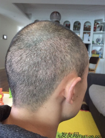 長沙大麥微針植發(fā)3510單位，一步步變帥的過程