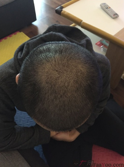 長沙大麥微針植發(fā)3510單位，一步步變帥的過程