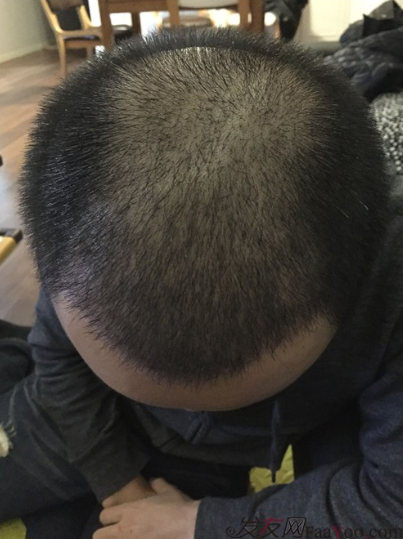 長沙大麥微針植發(fā)3510單位，一步步變帥的過程