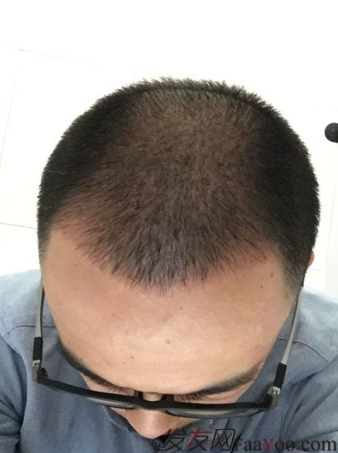 長沙大麥微針植發(fā)3510單位，一步步變帥的過程