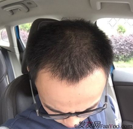 長沙大麥微針植發(fā)3510單位，一步步變帥的過程